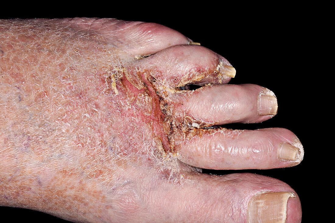 Ringworm and secondary bacterial infection of the foot