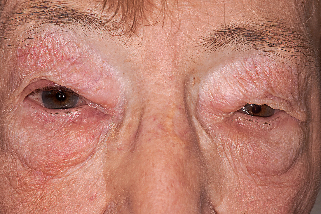 Angioedema of the eyelids due to drug reaction