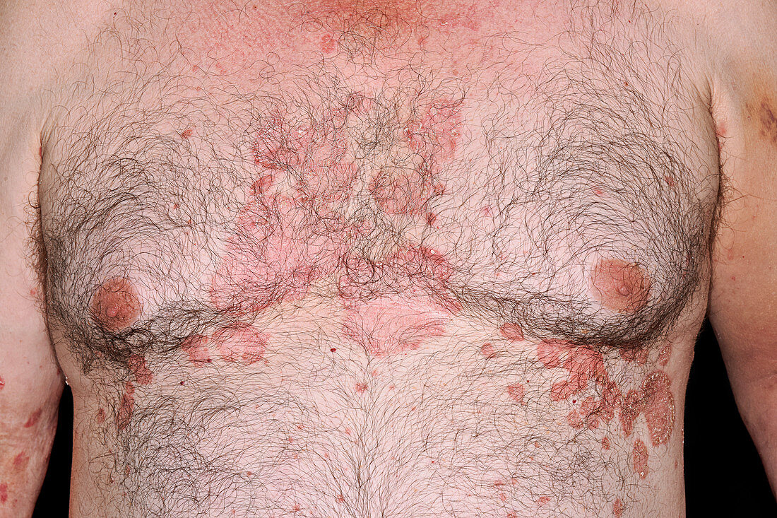 Psoriasis on the chest