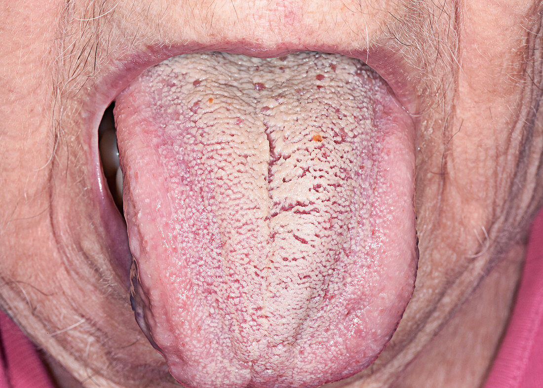 Angioedema of the tongue due to drug reaction
