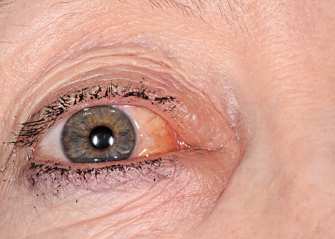 Conjunctival oedema due to allergy