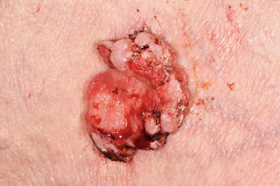 Polypoid basal cell carcinoma