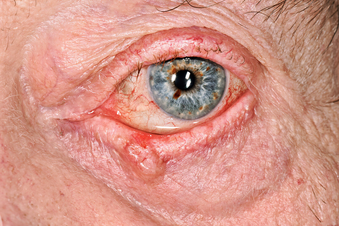 Basal cell carcinoma on the eyelid