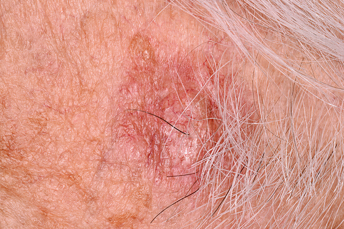 Basal cell carcinoma