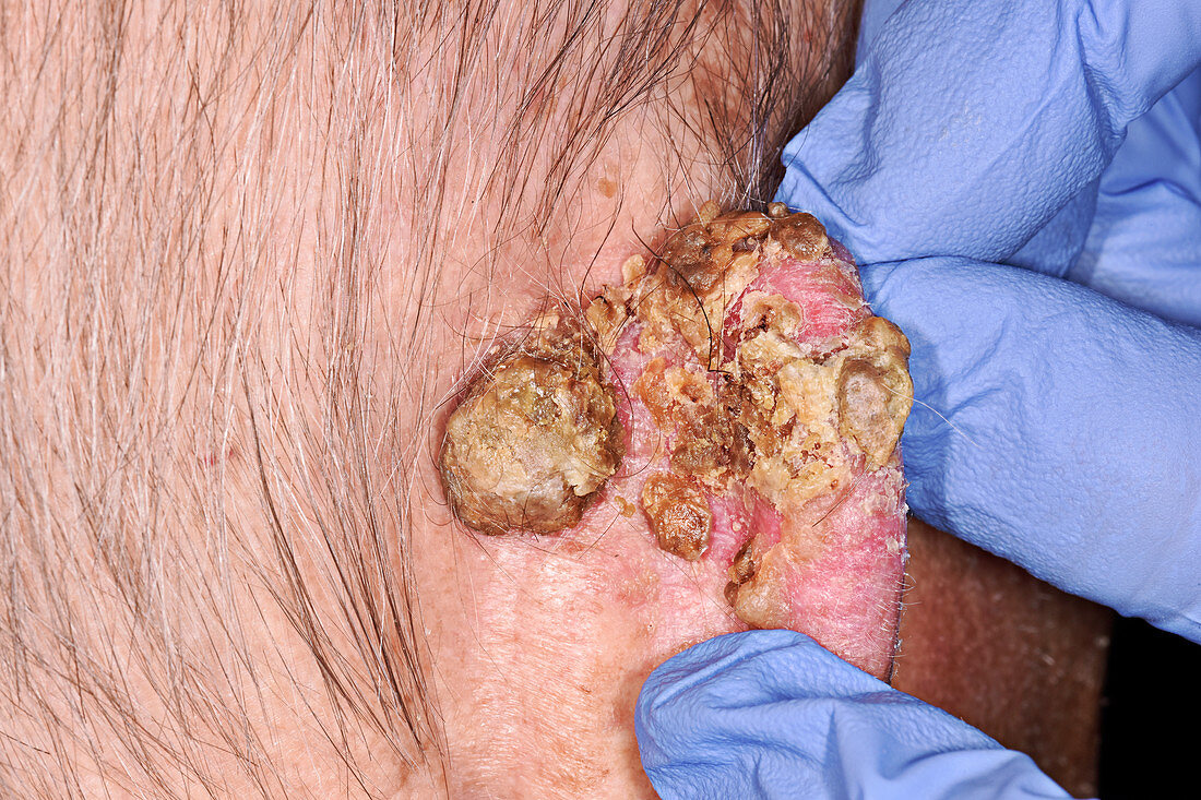 Squamous cell carcinoma