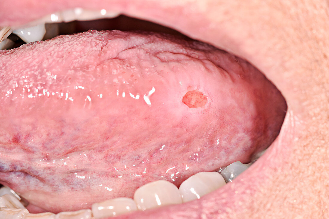 Aphthous ulcer of the tongue