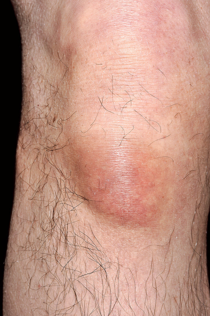 Swollen knee after injury