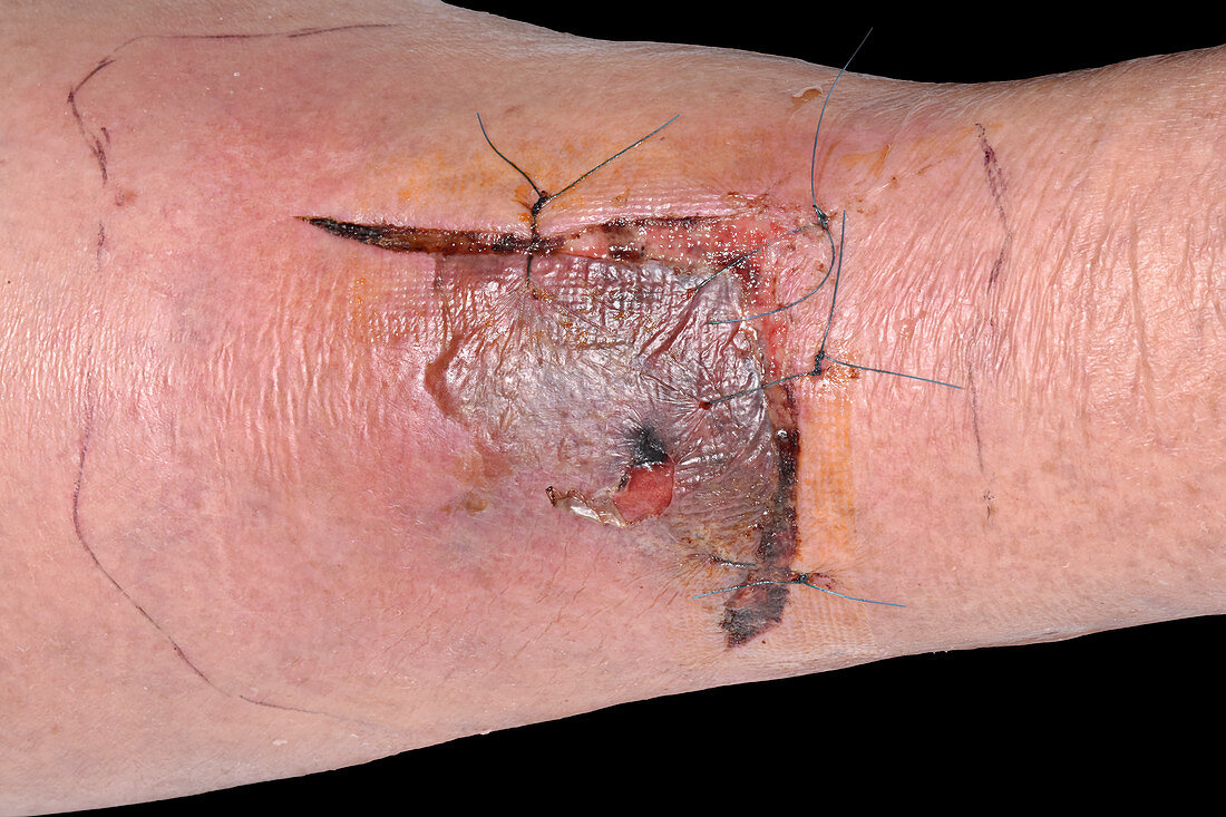 Stitched leg wound