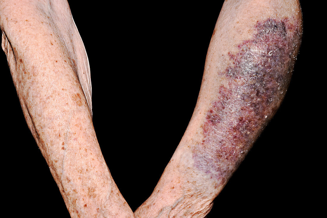 Haematoma on arm following an accident