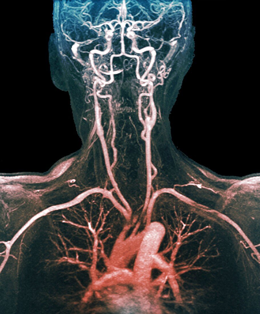 Chest, neck and head arteries, MRI angiogram