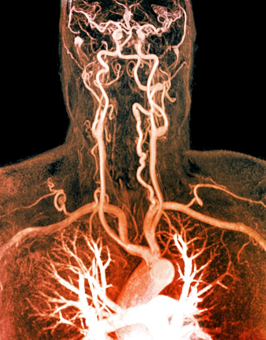 Cervical artery dissection, MRI angiogram