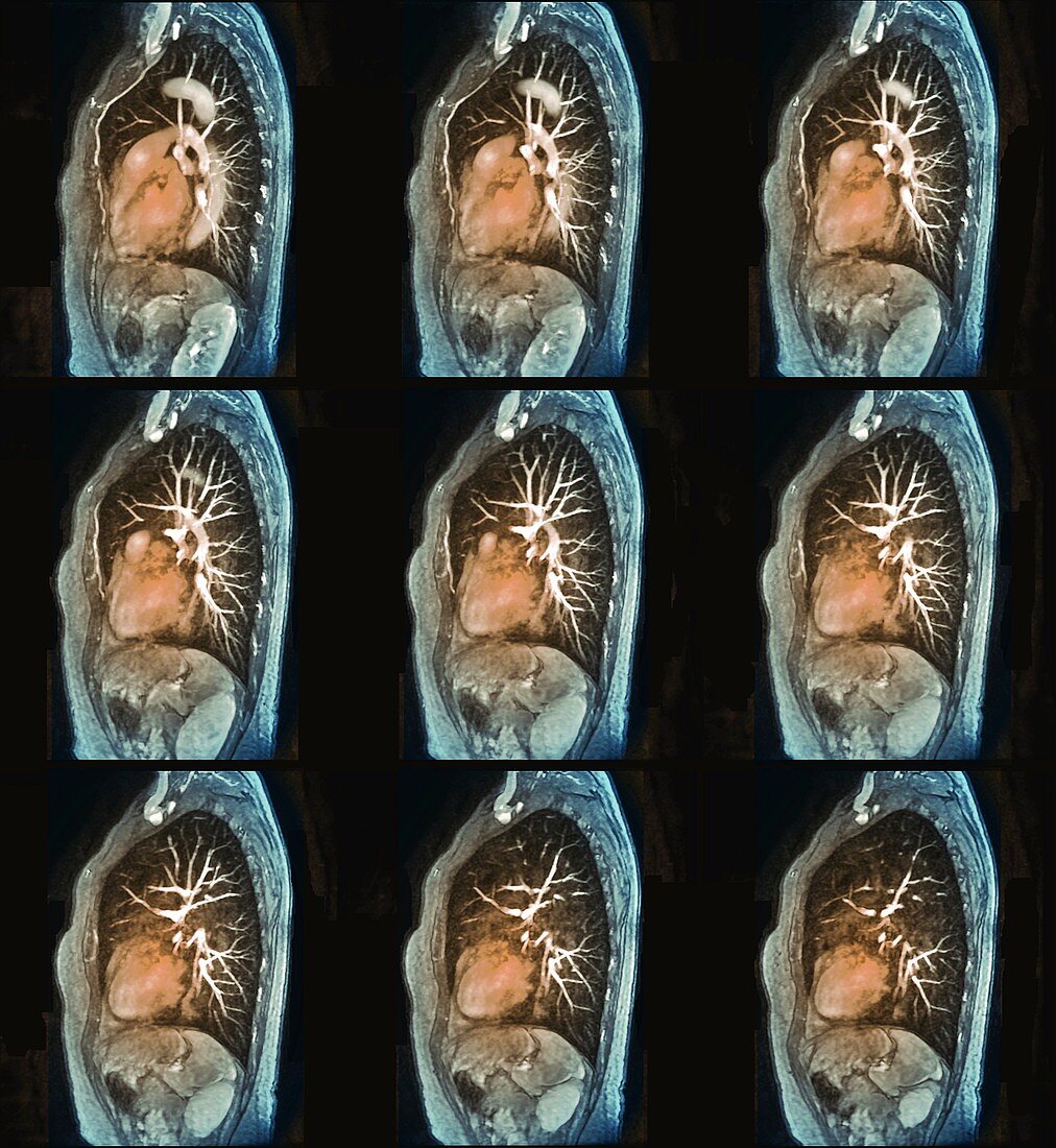 Heart-lung profiles, MRI angiograms