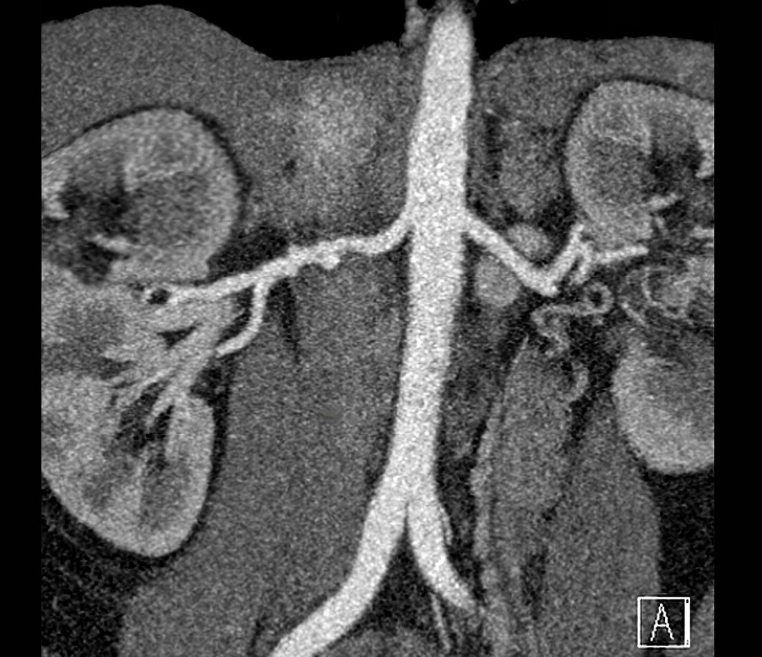 Fibromuscular dysplasia of renal artery, CT scan
