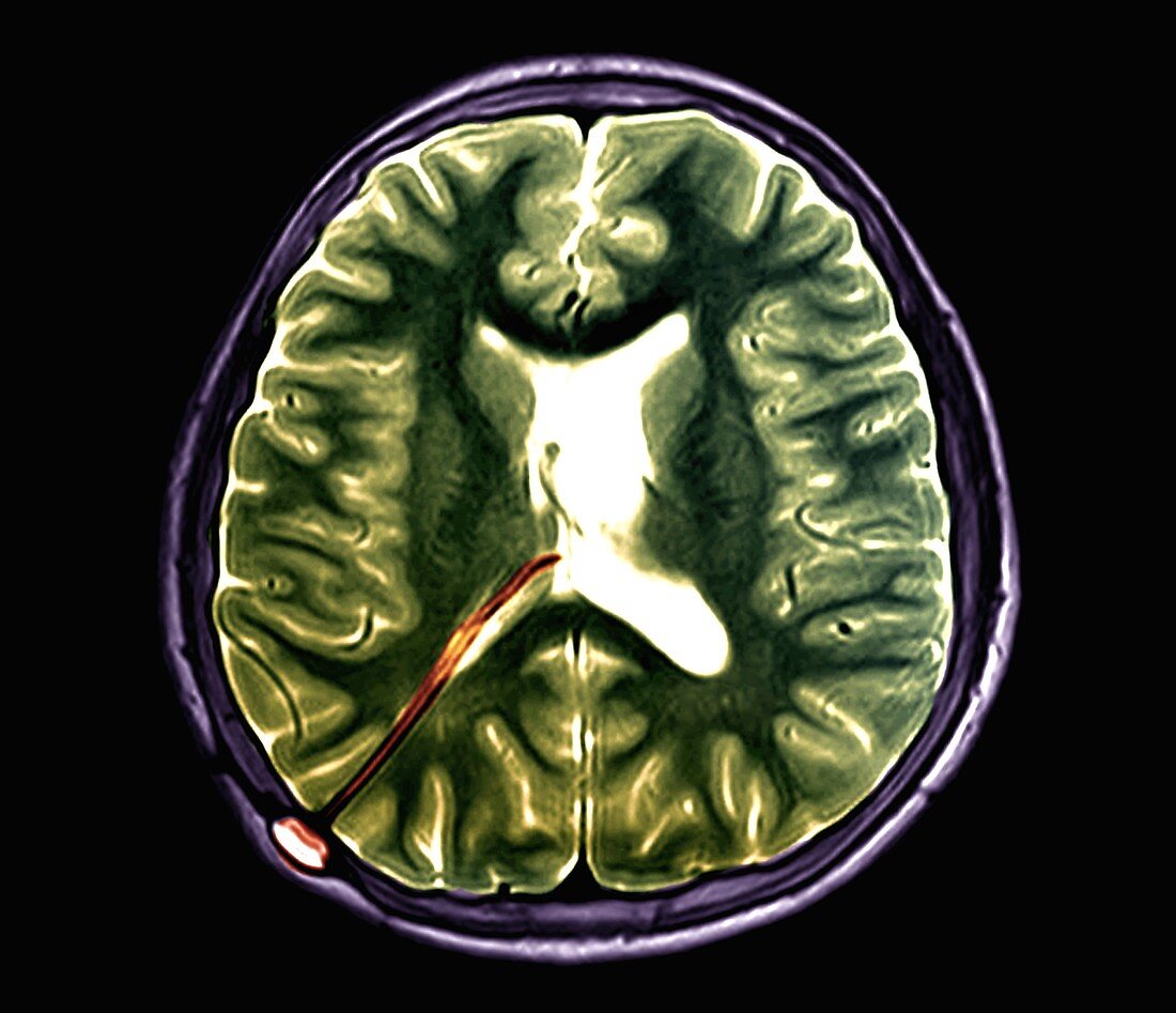 Hydrocephalus treatment, MRI scan