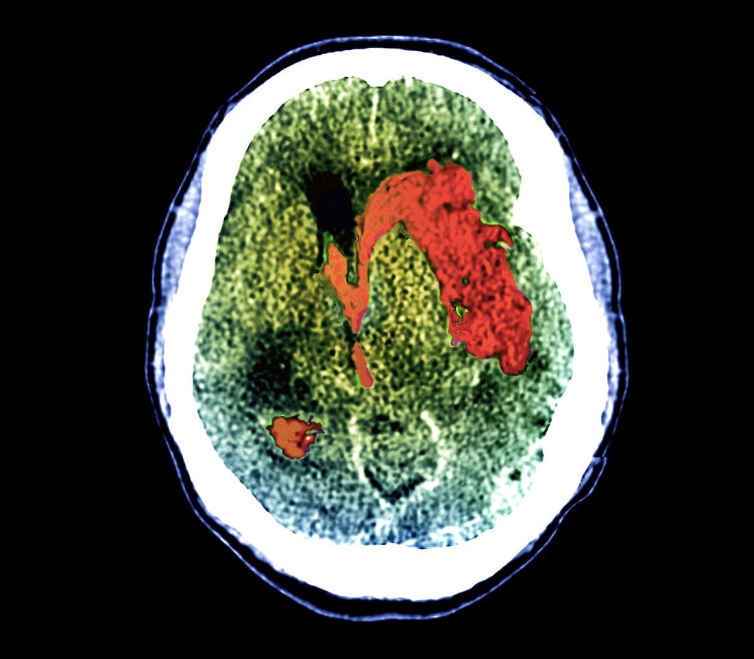 Stroke and intracerebral haemorrhage, CT scan