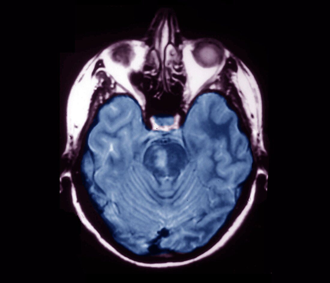 Brainstem stroke, MRI scan