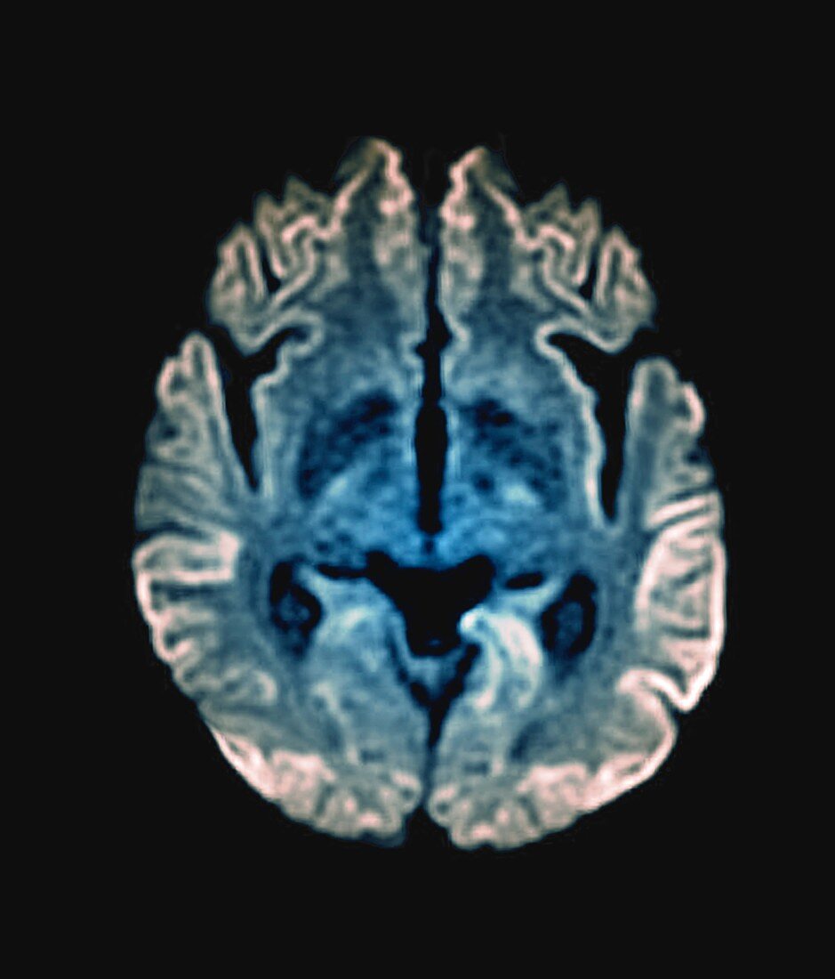 Creutzfeldt-Jakob disease, MRI scan