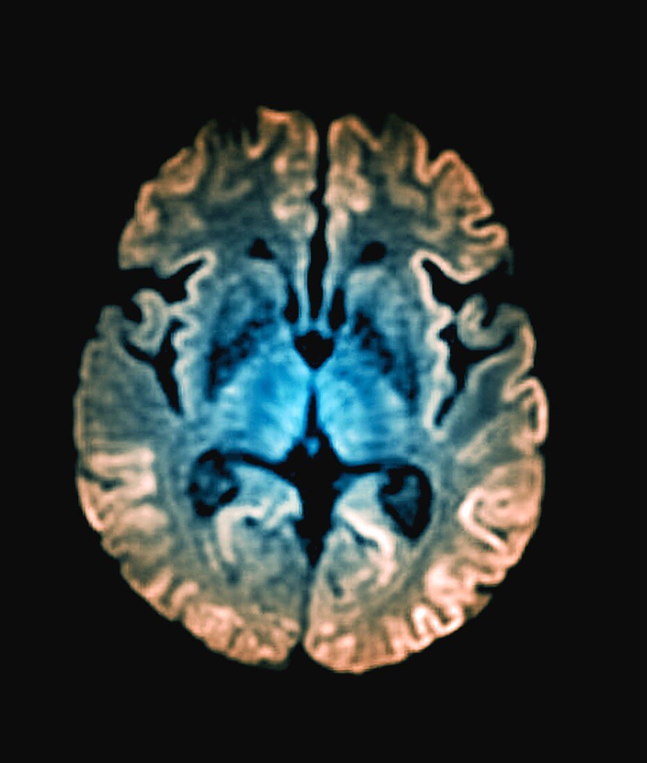 Creutzfeldt-Jakob disease, MRI scan