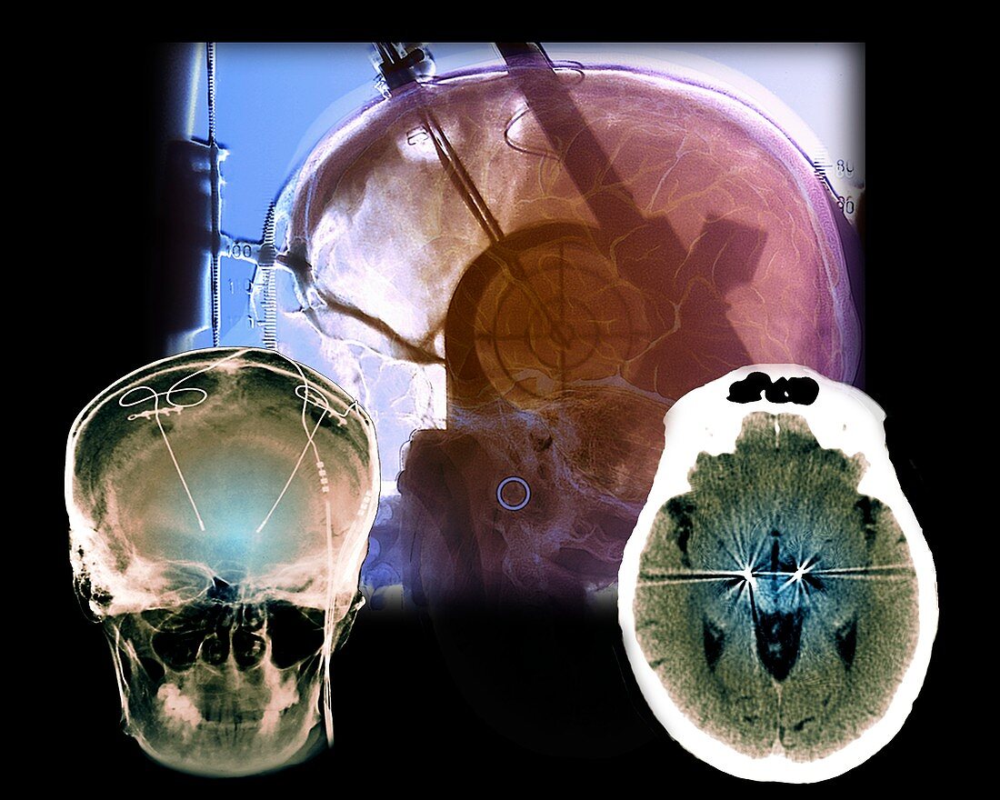 Parkinson's disease brain stimulation operation