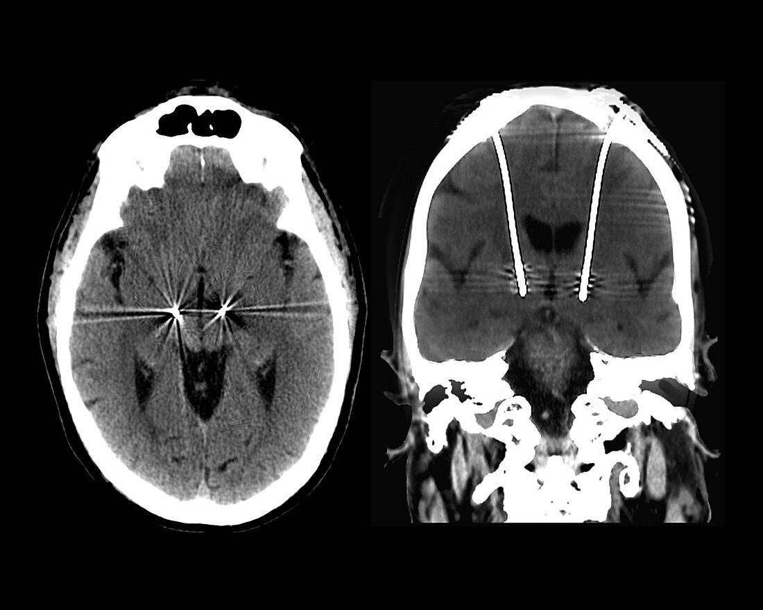 Parkinson's disease brain stimulation electrodes, CT scans