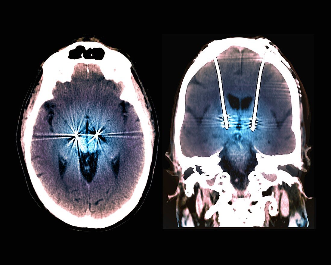 Parkinson's disease brain stimulation electrodes, CT scans