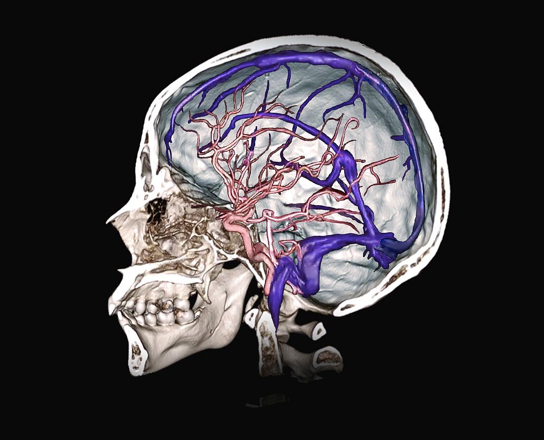 Brain arteries and venous sinuses, 3D CT angiogram