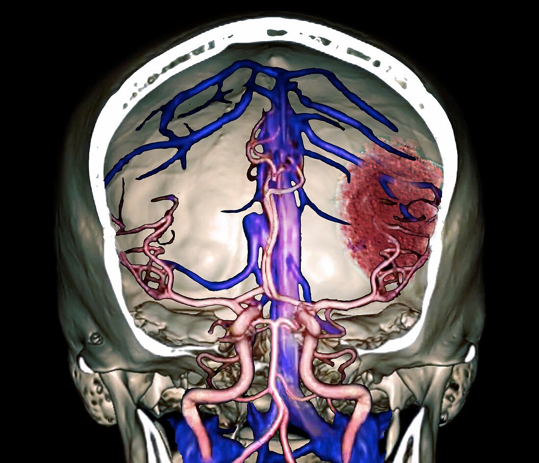 Stroke and intracerebral haemorrhage, 3D CT angiogram