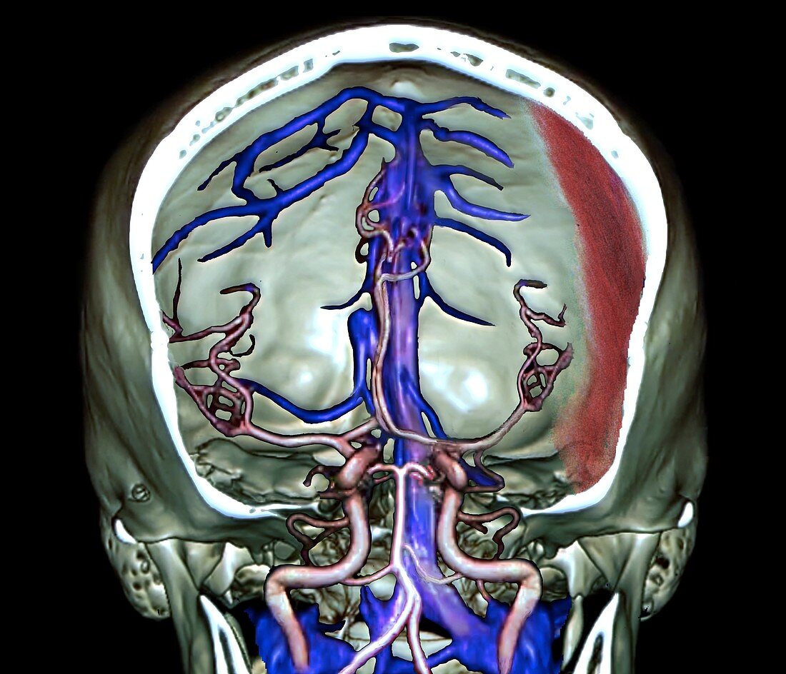 Subdural haematoma, 3D CT angiogram