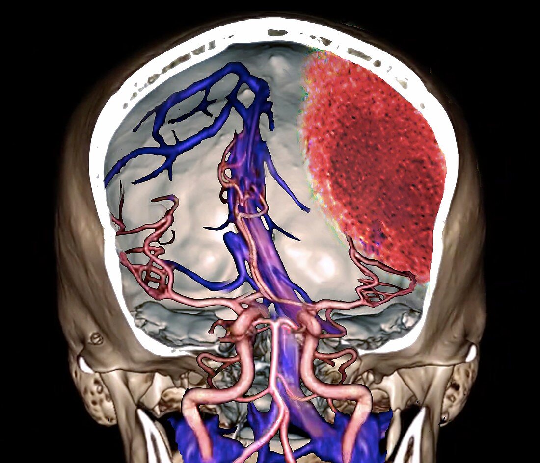 Extradural haematoma, 3D CT angiogram