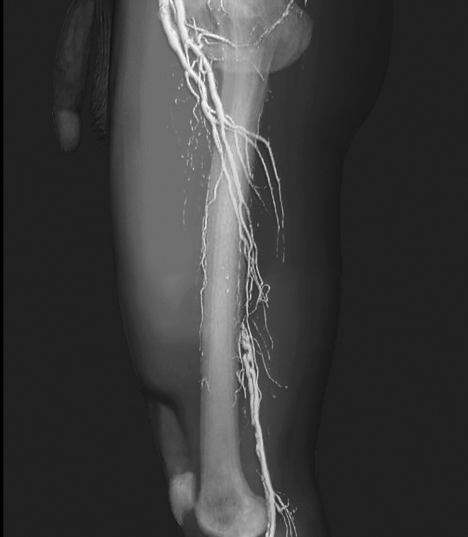 Nearly blocked femoral arteries, 3D CT angiogram