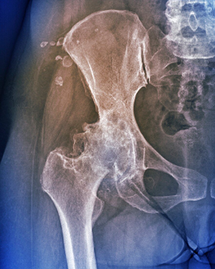 Osteoarthritis of the hip, X-ray
