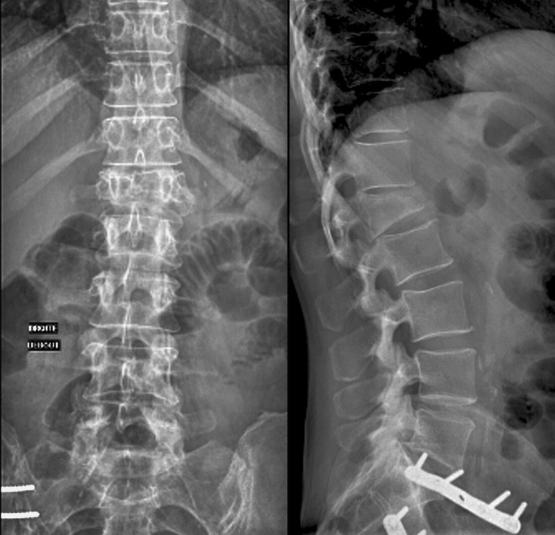 Compression fracture of a lumbar vertebra, X-ray