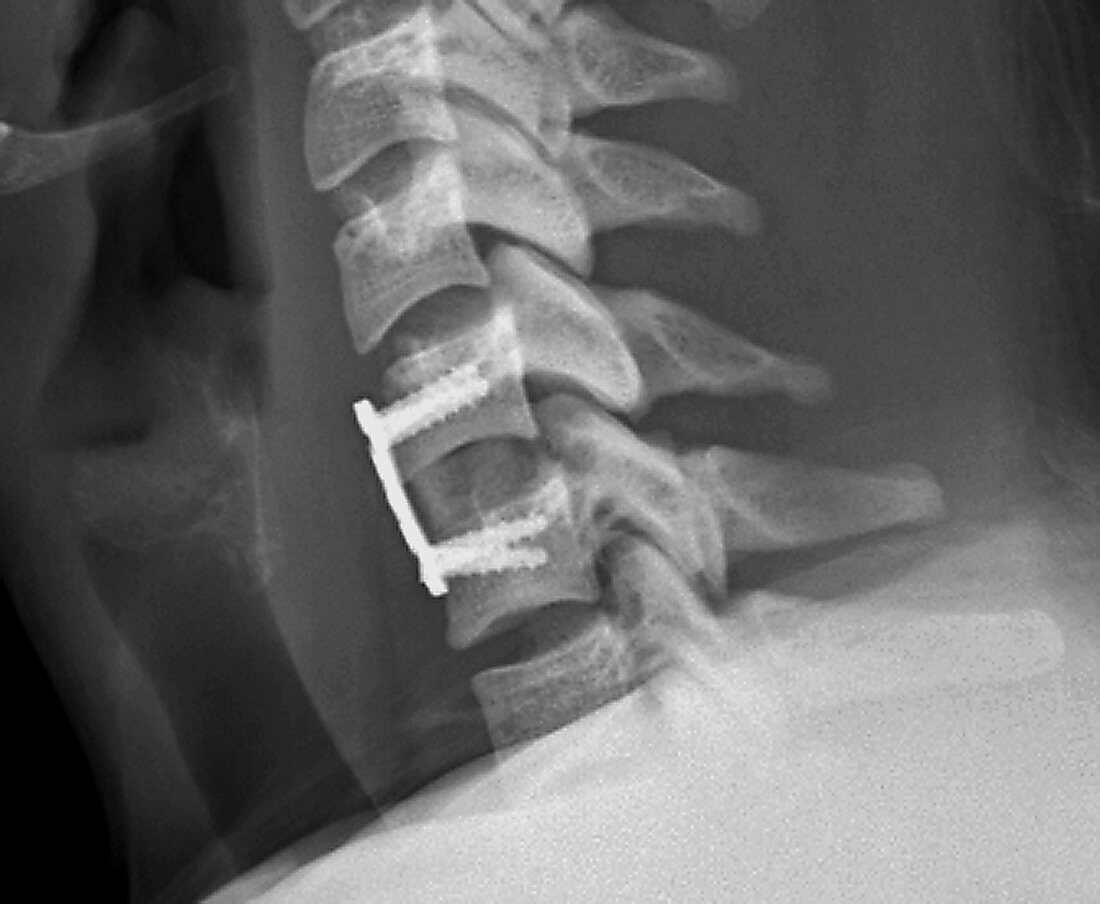 Cervical vertebral implant and repair, X-ray
