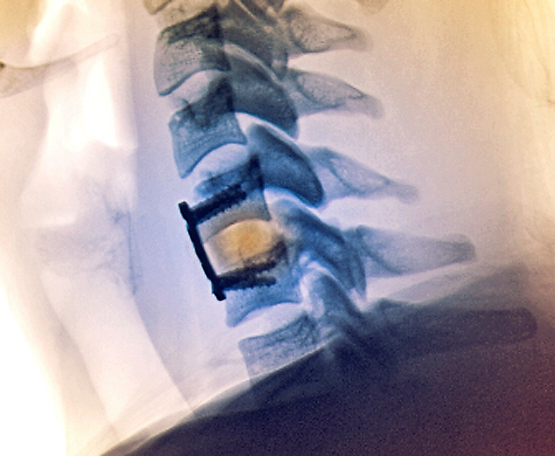 Cervical vertebral implant and repair, X-ray