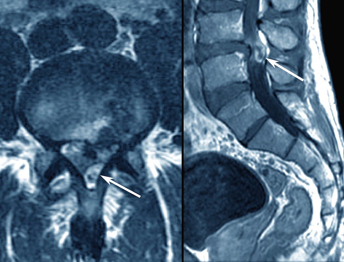 Slipped disc in the lumbar spine, MRI scans