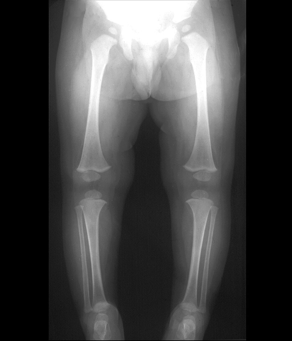 Leg bones of 18-month-old infant, X-ray