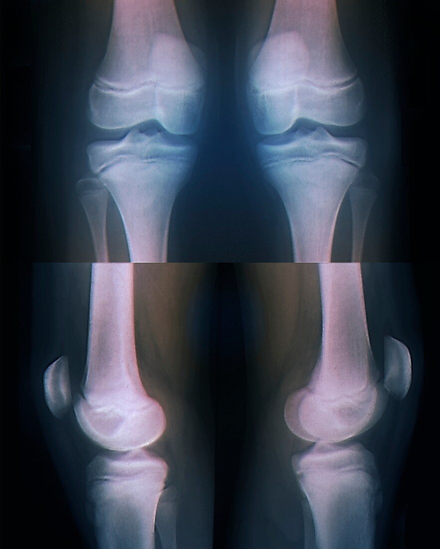 Teenage girl's knees, bilateral X-rays