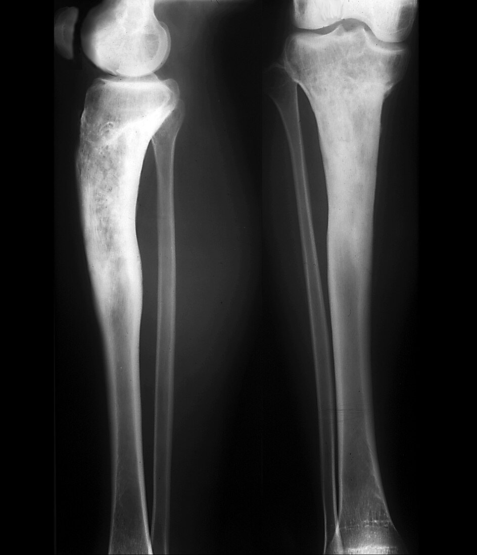 Osteomyelitis in the lower leg, X-rays