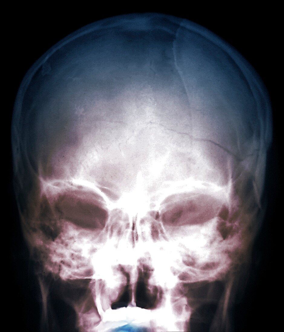Skull fracture, X-ray