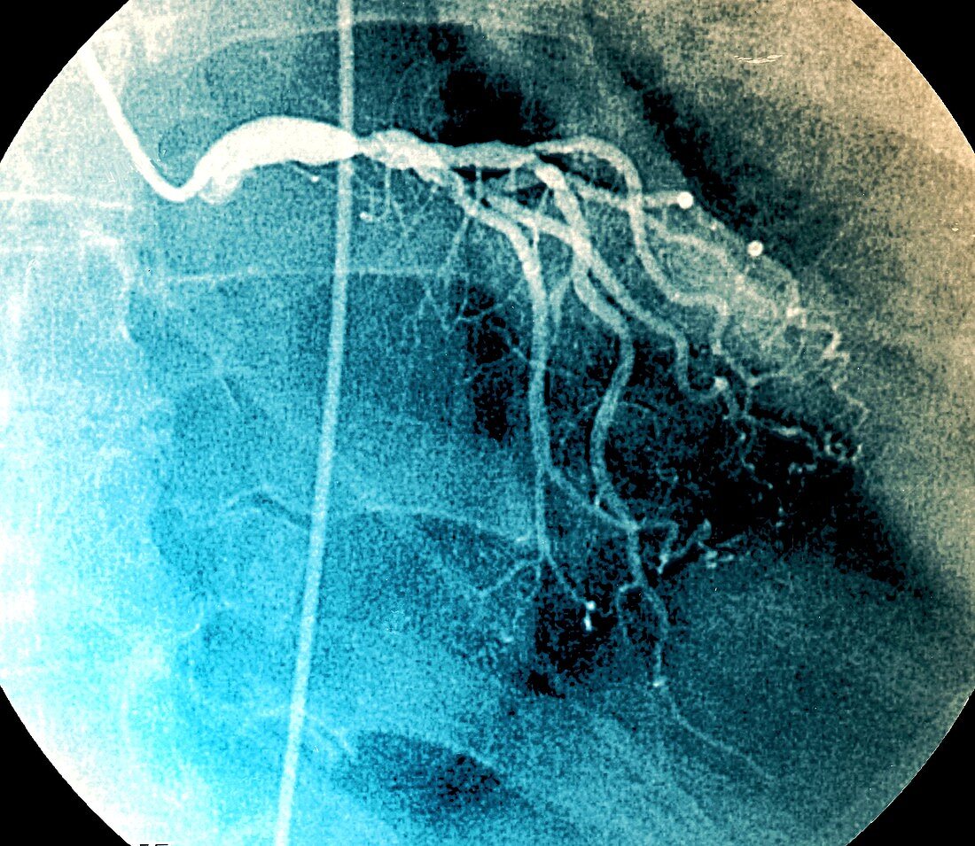 Left coronary artery, coronarography scan