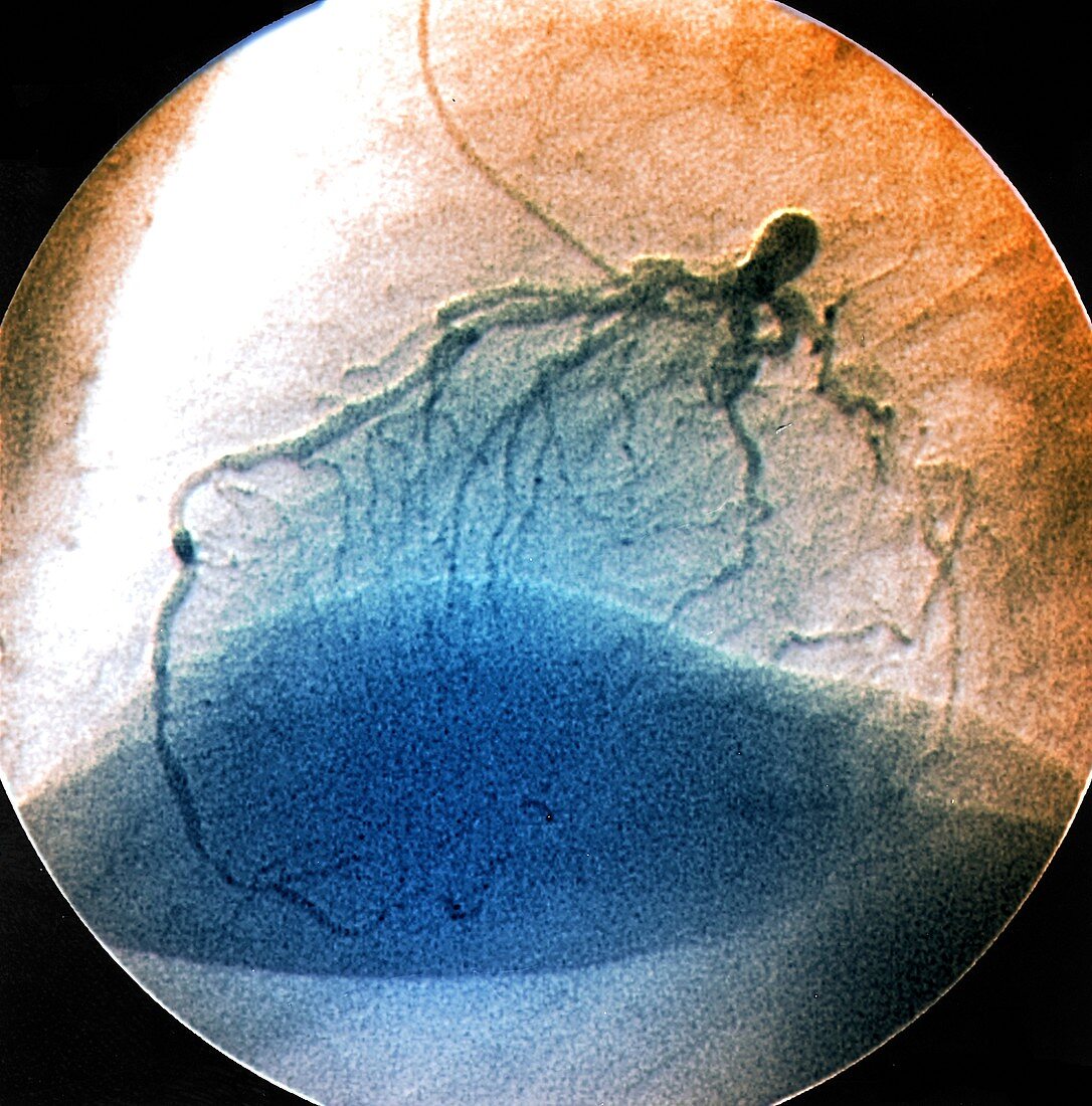 Coronary artery stenosis, coronarography scan