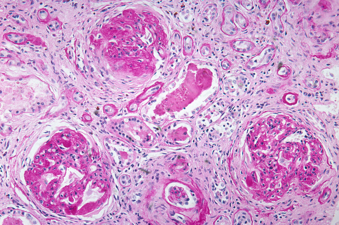 Kidney, Amyloid Deposits, LM