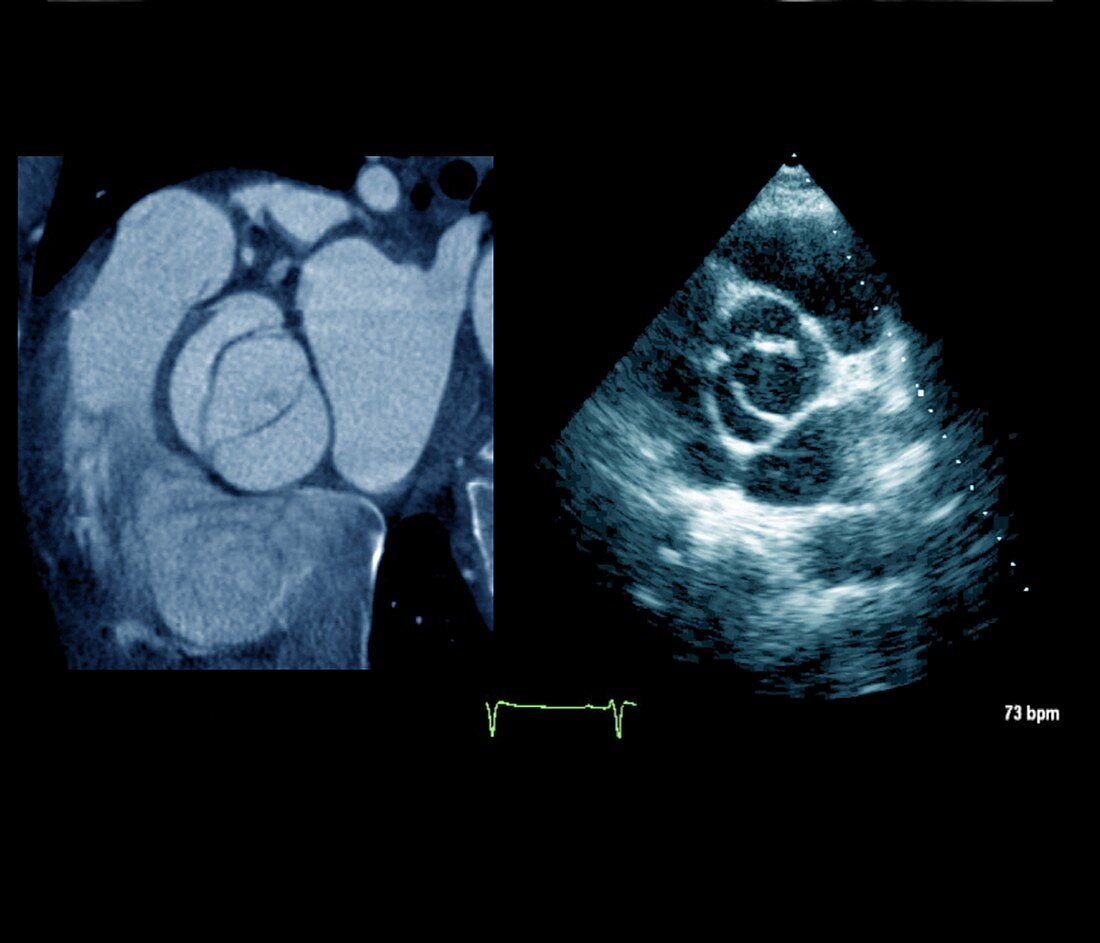 Aortic valve congenital deformity, CT and ultrasound scans