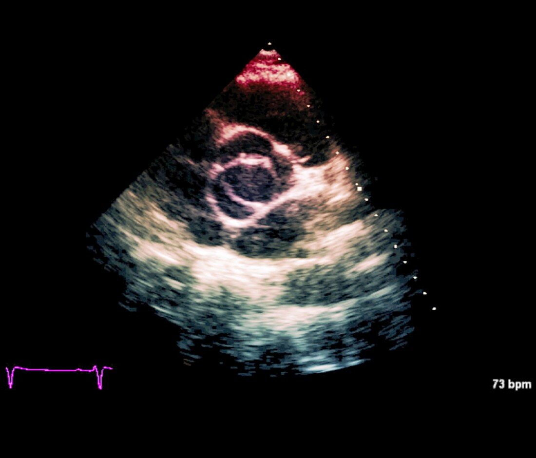 Aortic valve congenital deformity, cardiac ultrasound scan