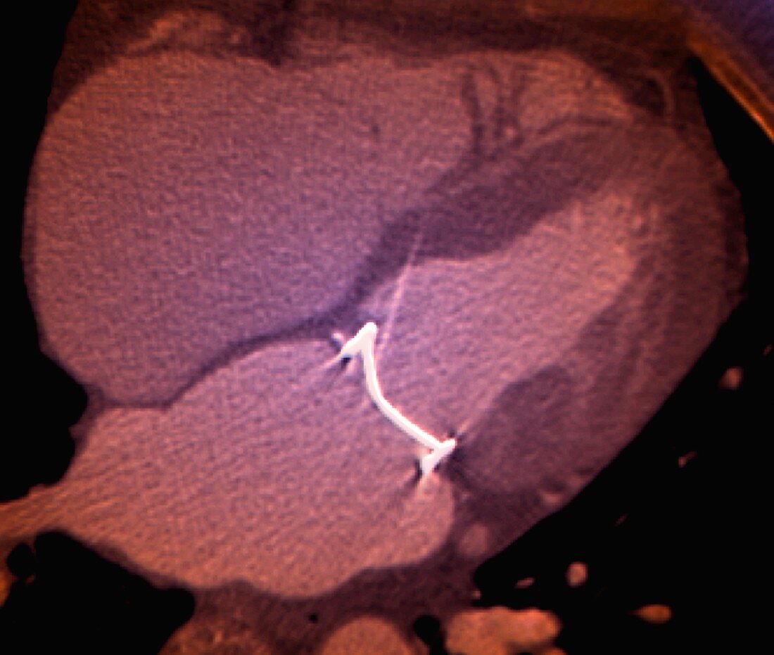 Mitral valve replacement, CT scan