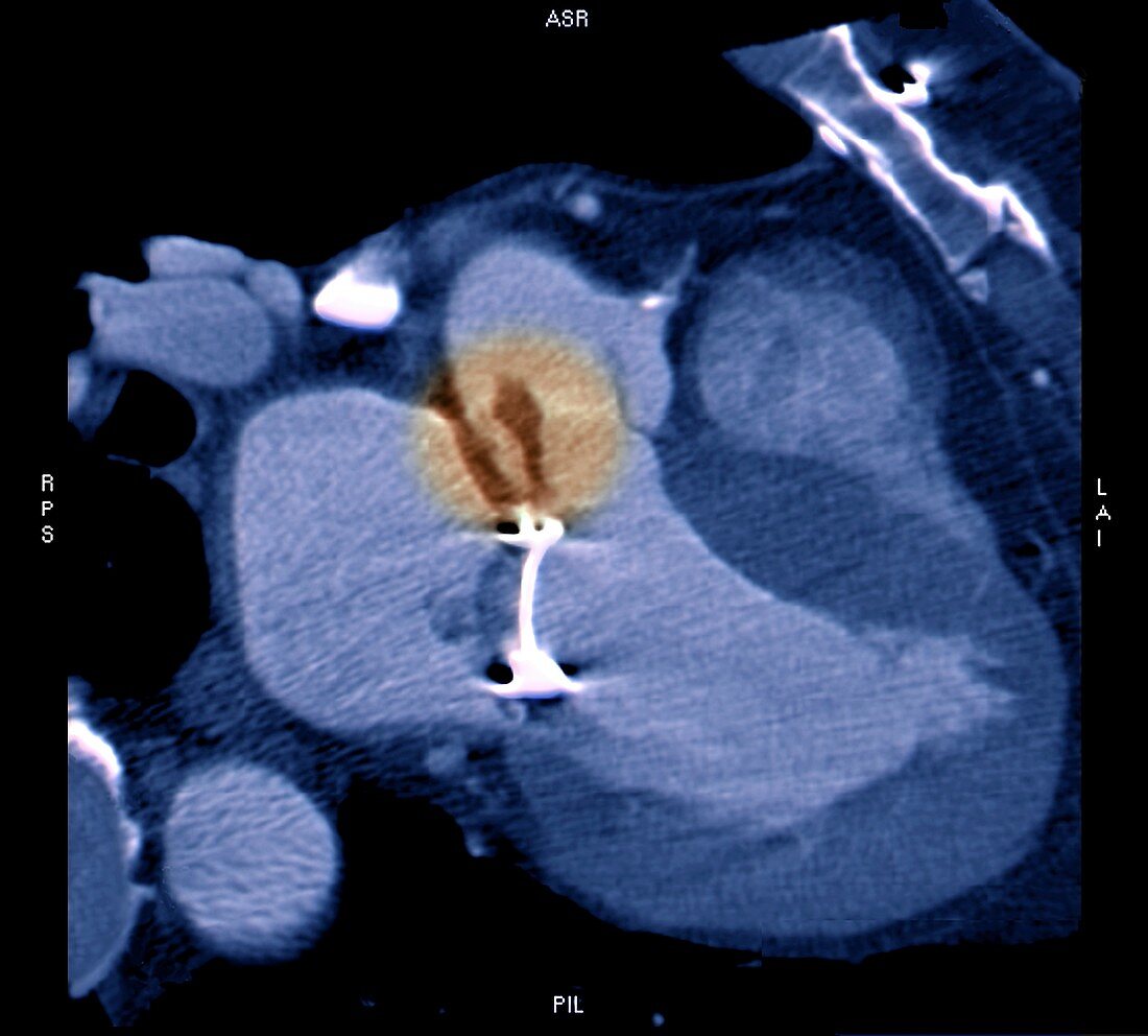 Leaky mitral valve replacement, CT scan