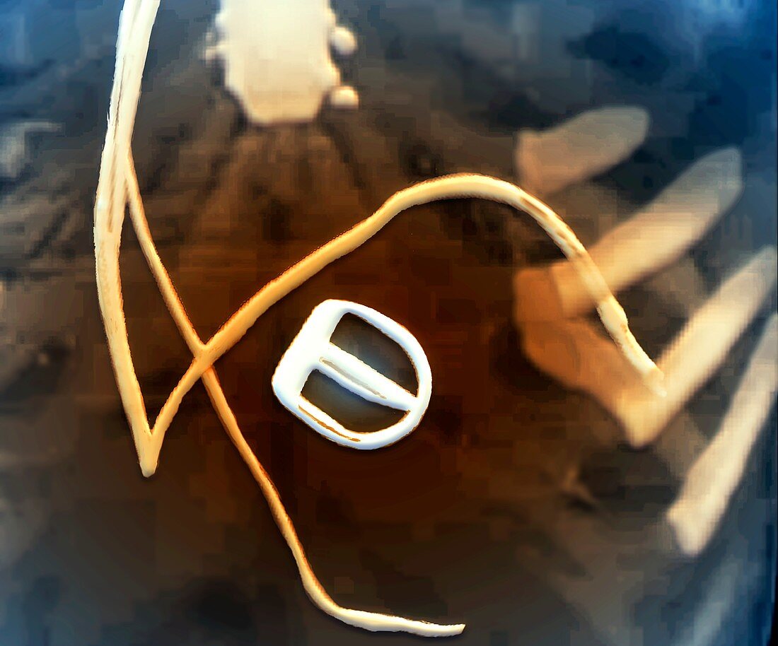 Prosthetic aortic valve and pacemaker wires, CT scan