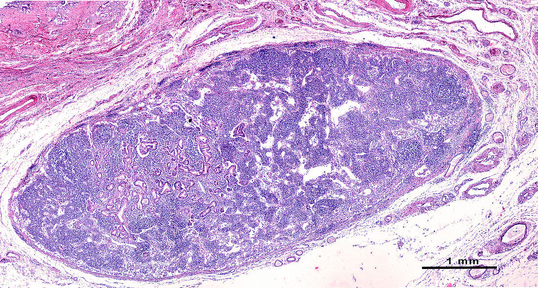 Lymph node metastasis, light micrograph