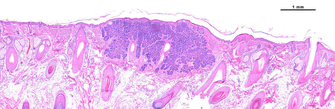 Basal cell carcinoma, light micrograph