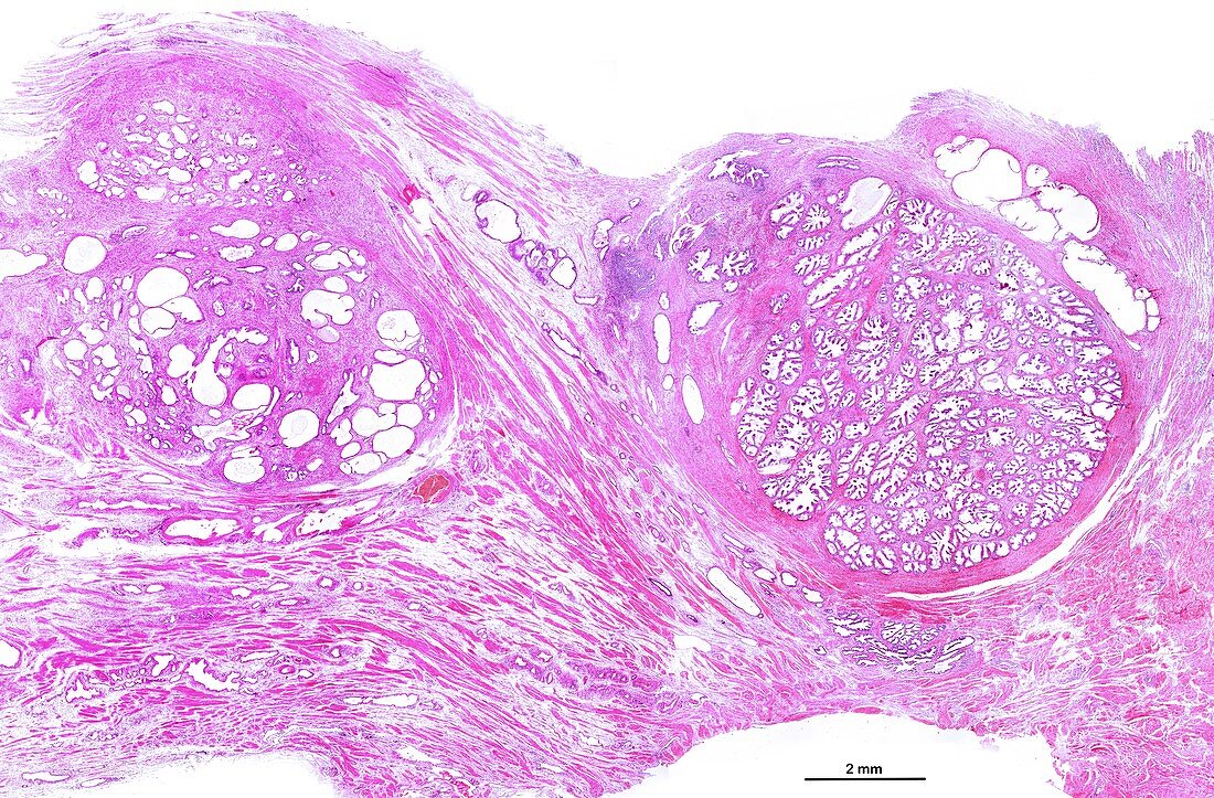 Benign prostatic hyperplasia, light micrograph